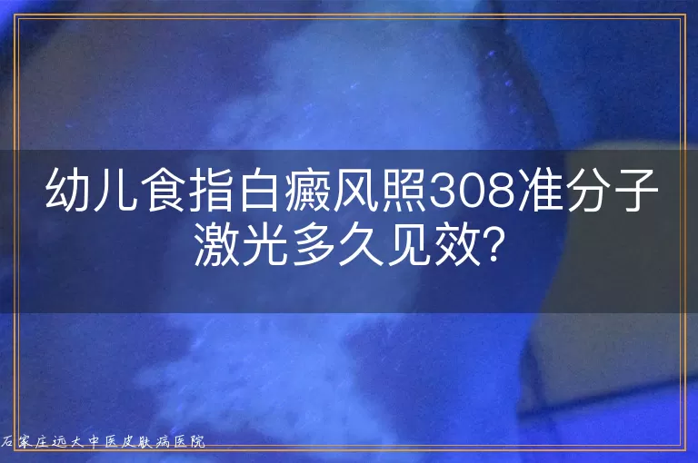幼儿食指白癜风照308准分子激光多久见效？