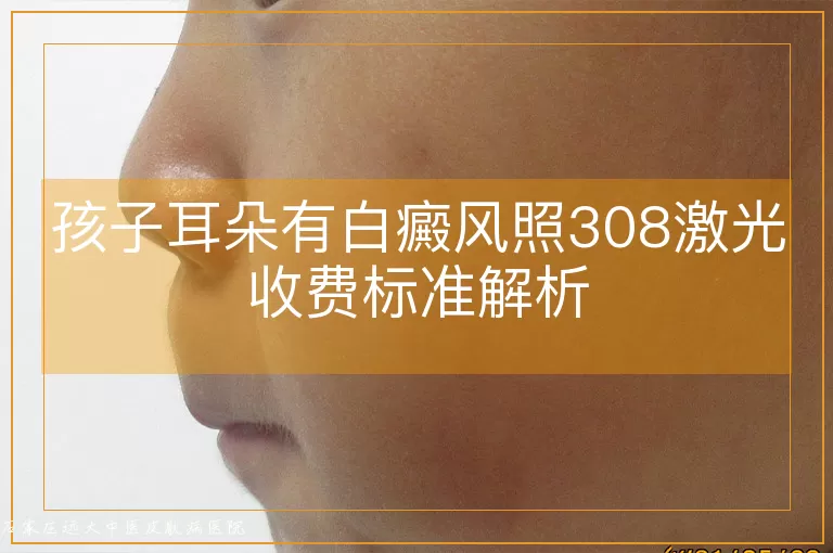 孩子耳朵有白癜风照308激光收费标准解析